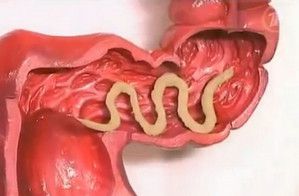 intestinal worms treatment