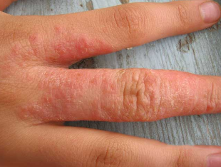 Worms skin rashes during